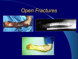 Open FracturesOpen Fractures
 