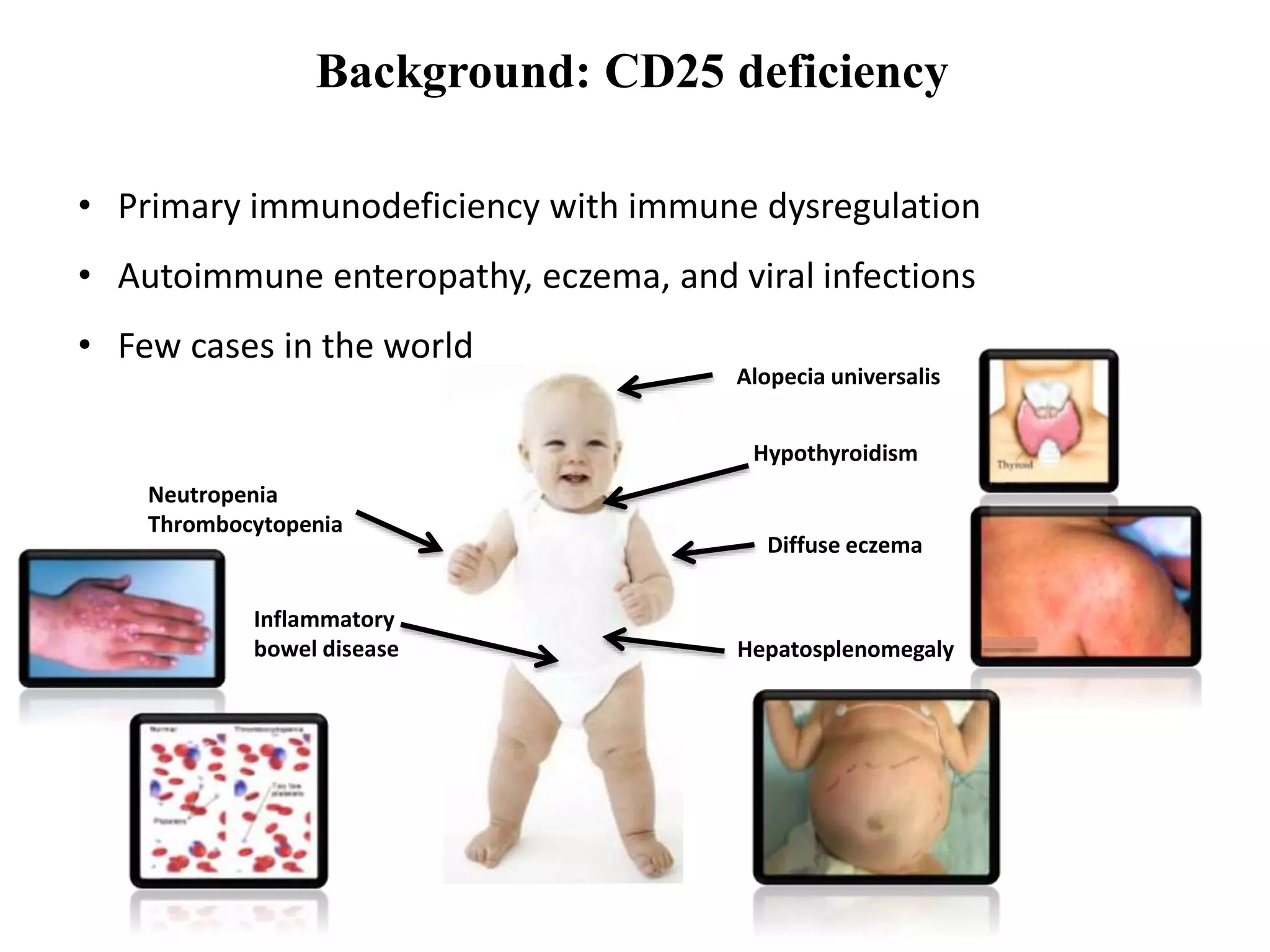 Background: CD25 deficiency
• Primary immunodeficiency with immune dysregulation
• Autoimmune enteropathy, eczema, and viral infections
• Few cases in the world
Diffuse eczema
Neutropenia
Thrombocytopenia
Inflammatory
bowel disease
Alopecia universalis
Hypothyroidism
Hepatosplenomegaly
 