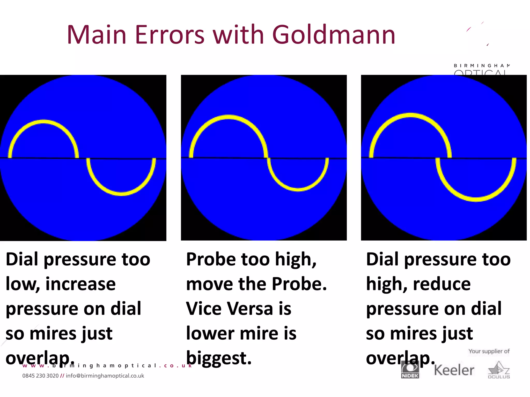Dial pressure too
low, increase
pressure on dial
so mires just
overlap.
Dial pressure too
high, reduce
pressure on dial
so mires just
overlap.
Probe too high,
move the Probe.
Vice Versa is
lower mire is
biggest.
Main Errors with Goldmann
 