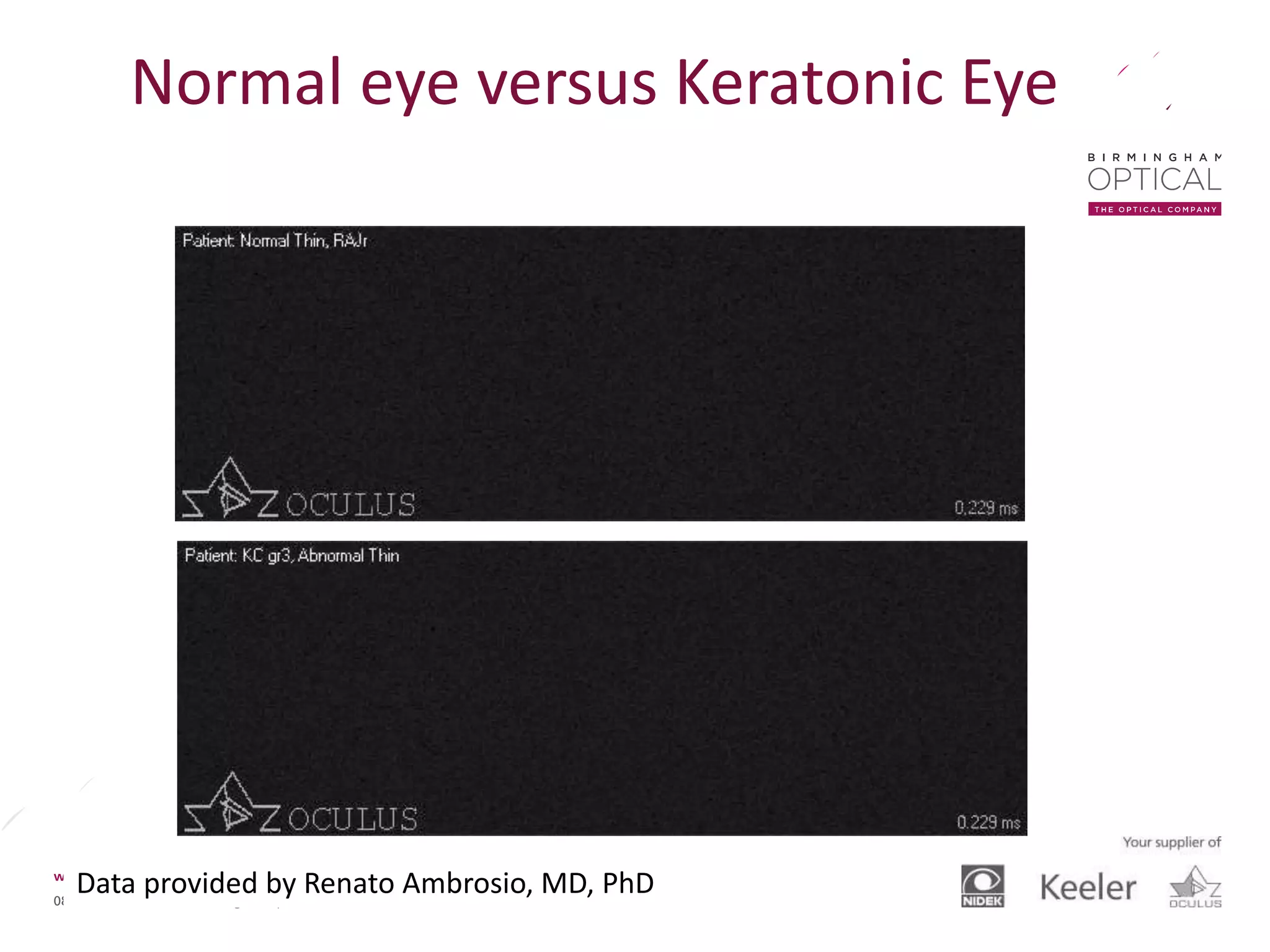Data provided by Renato Ambrosio, MD, PhD
Normal eye versus Keratonic Eye
 
