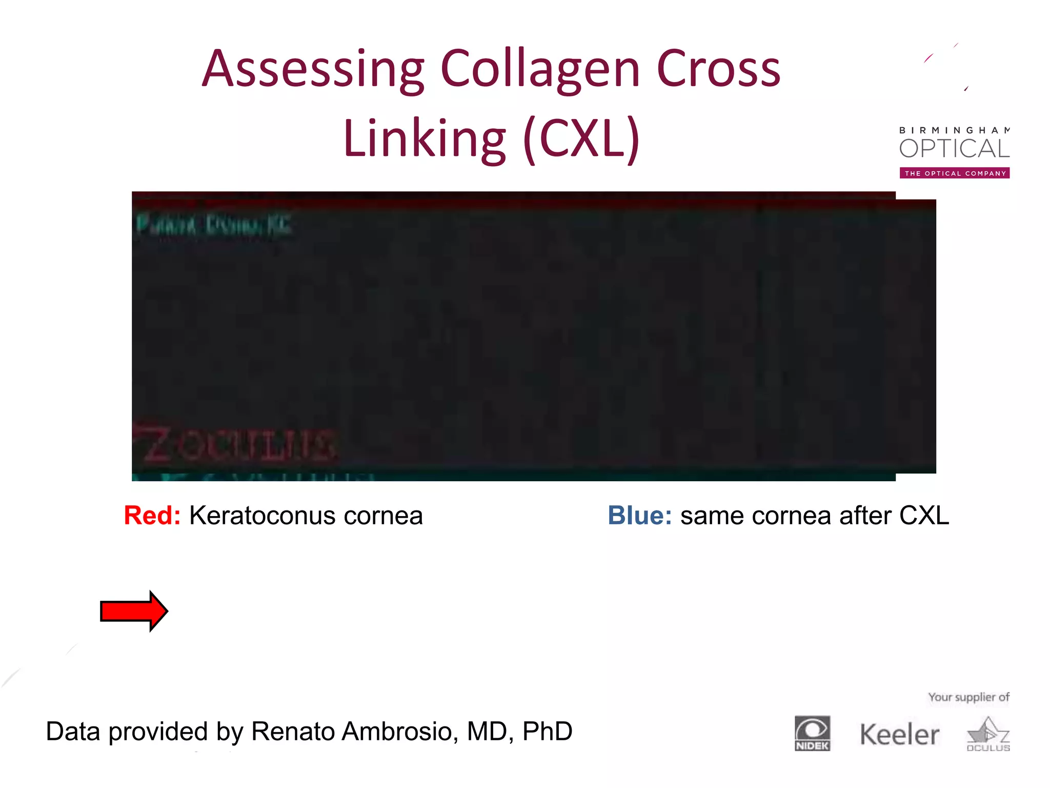 greater stability in post-op “blue” image than in
pre-op “red” image
Data provided by Renato Ambrosio, MD, PhD
Red: Keratoconus cornea Blue: same cornea after CXL
Assessing Collagen Cross
Linking (CXL)
 