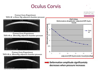 Oculus Corvis
Contact Lens Experiment
TAN 40 at 0mm Hg adjusted chamber pressure
Contact Lens Experiment
TAN 40 at 20mmHg adjusted chamber pressure
Contact Lens Experiment
TAN 40 at 60mmHg adjusted chamber pressure
Deformation amplitude significantaly
decreases when pressure increases
 
