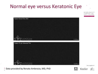 Data provided by Renato Ambrosio, MD, PhD
Normal eye versus Keratonic Eye
 
