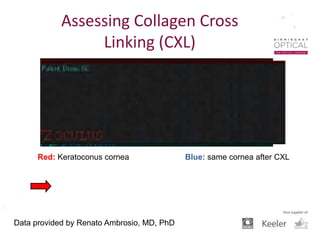 greater stability in post-op “blue” image than in
pre-op “red” image
Data provided by Renato Ambrosio, MD, PhD
Red: Keratoconus cornea Blue: same cornea after CXL
Assessing Collagen Cross
Linking (CXL)
 