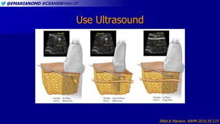 @EMARIANOMD #CSAHSWinter20
Use Ultrasound
Ilfeld & Mariano. RAPM 2010;35:123
 