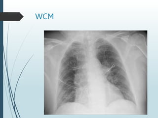 WCM
 