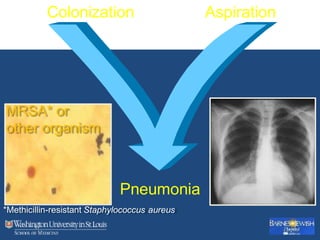 Colonization Aspiration
*Methicillin-resistant Staphylococcus aureus
MRSA* or
other organism
Pneumonia
 