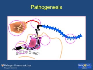 Pathogenesis
 
