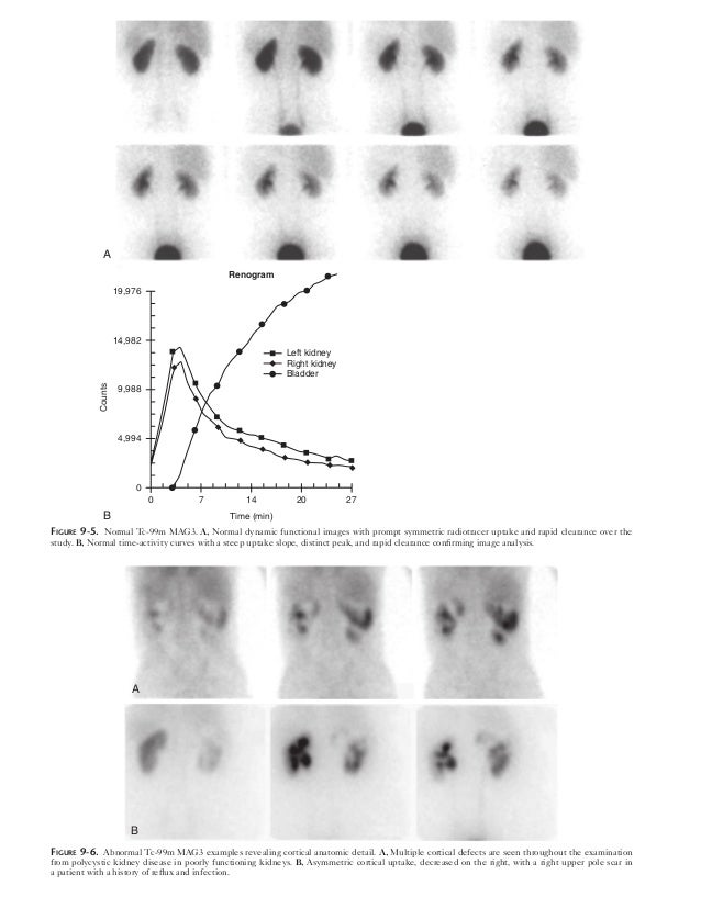 Mag3 renal scan with lasix