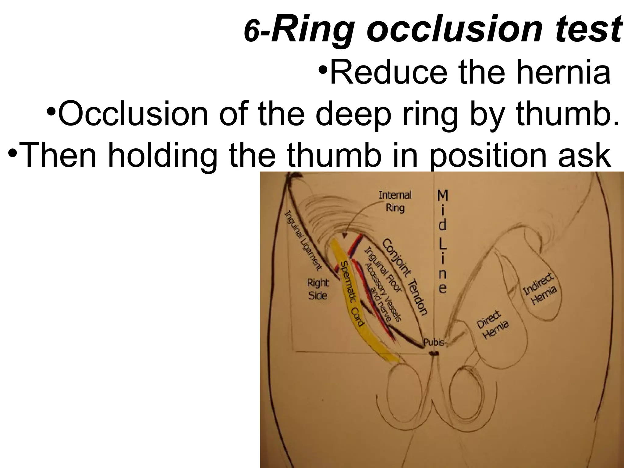 6-Ring occlusion test
•Reduce the hernia
•Occlusion of the deep ring by thumb.
•Then holding the thumb in position ask
The pt to stand
then cough
•If no bulging;
indirect
•If bulging;
direct .
 