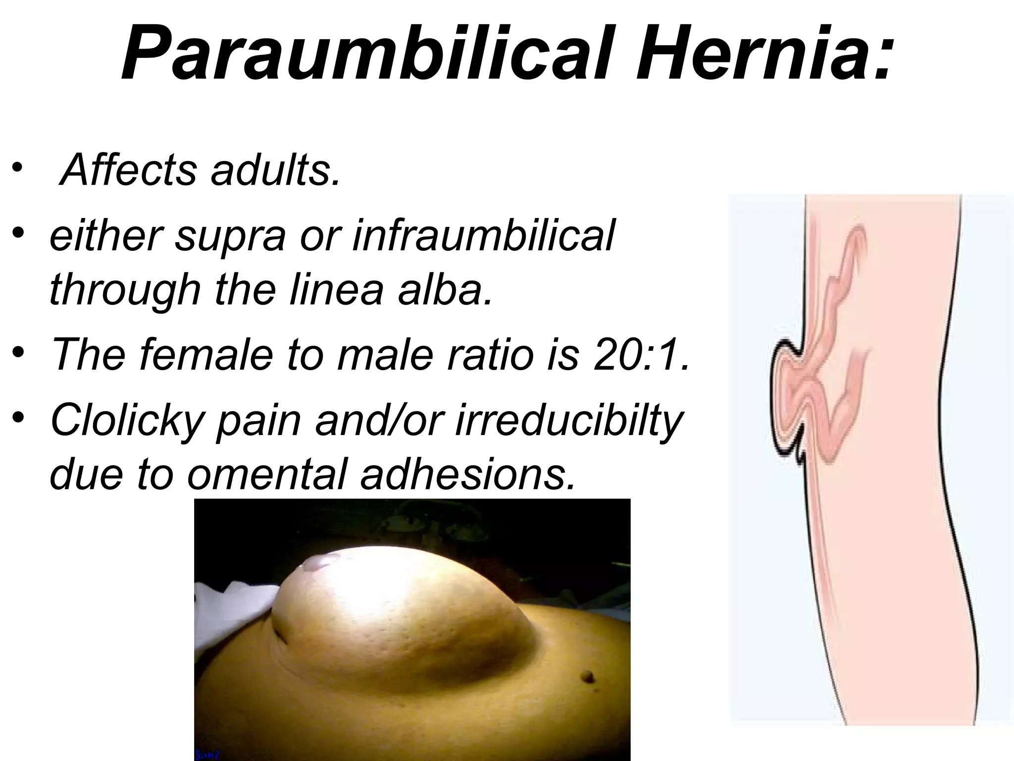 Paraumbilical Hernia:
• Affects adults.
• either supra or infraumbilical
through the linea alba.
• The female to male ratio is 20:1.
• Clolicky pain and/or irreducibilty
due to omental adhesions.
 
