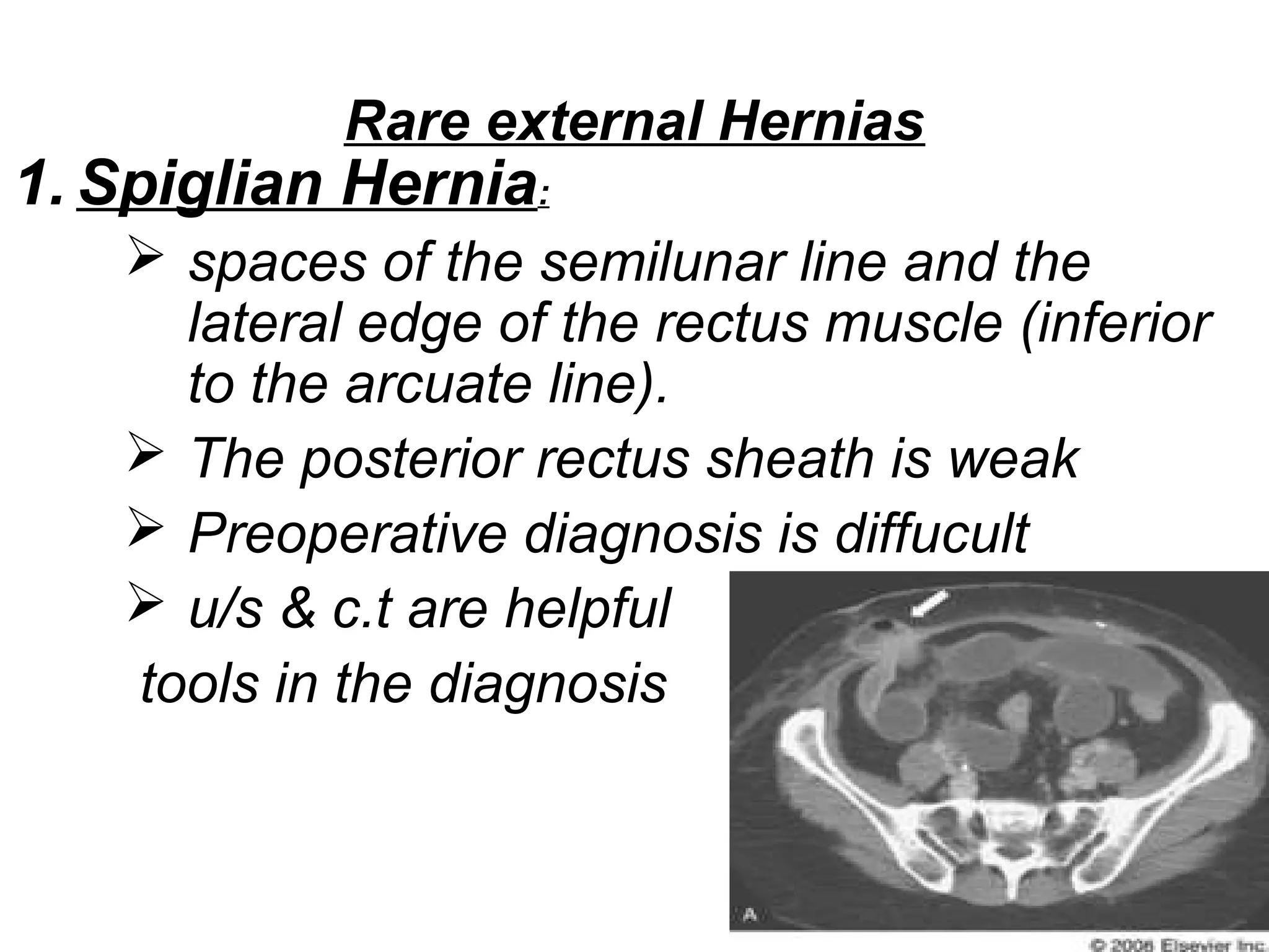Rare external Hernias
1. Spiglian Hernia:
 spaces of the semilunar line and the
lateral edge of the rectus muscle (inferior
to the arcuate line).
 The posterior rectus sheath is weak
 Preoperative diagnosis is diffucult
 u/s & c.t are helpful
tools in the diagnosis
 