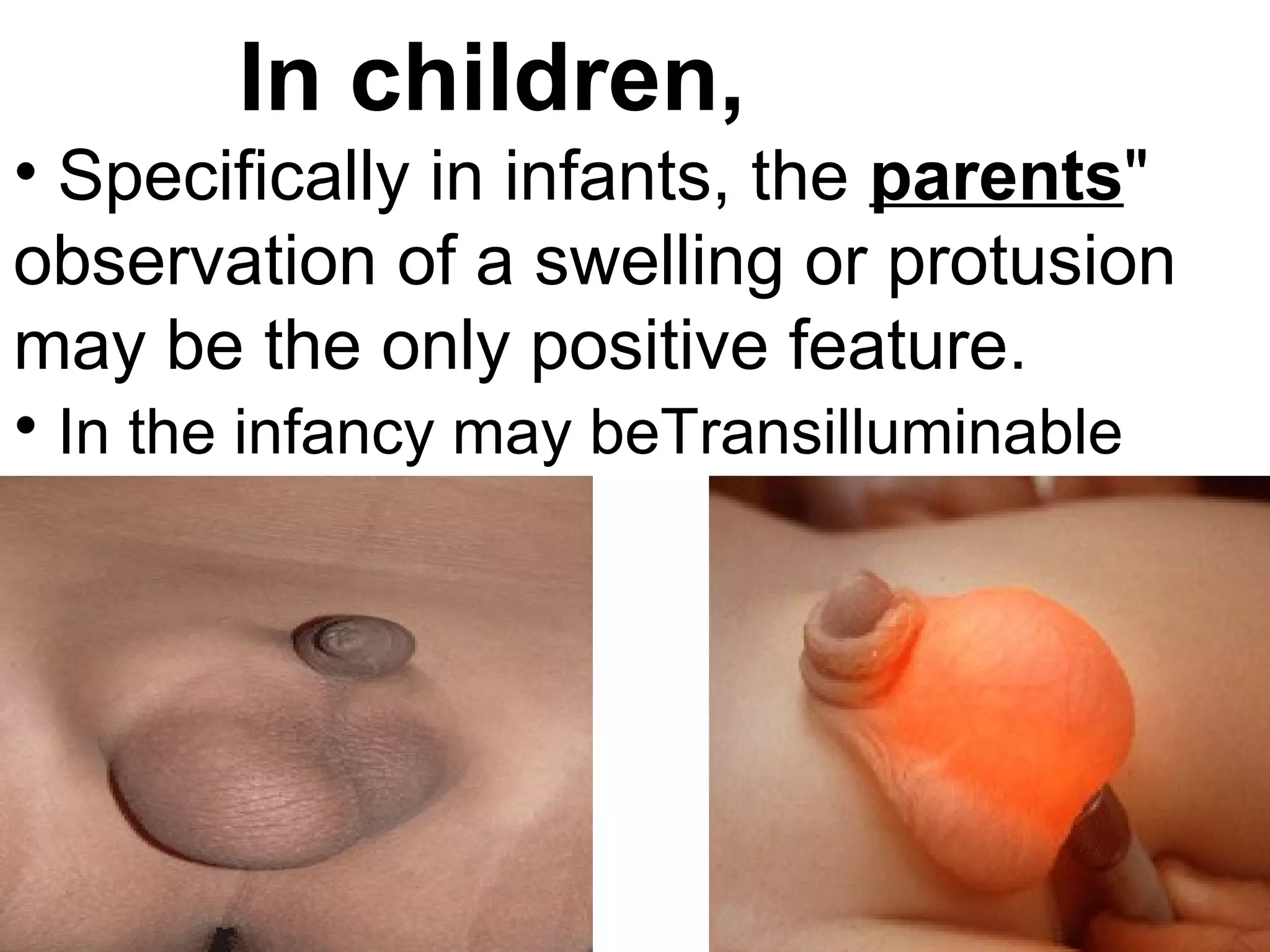 In children,
• Specifically in infants, the parents"
observation of a swelling or protusion
may be the only positive feature.
• In the infancy may beTransilluminable
 