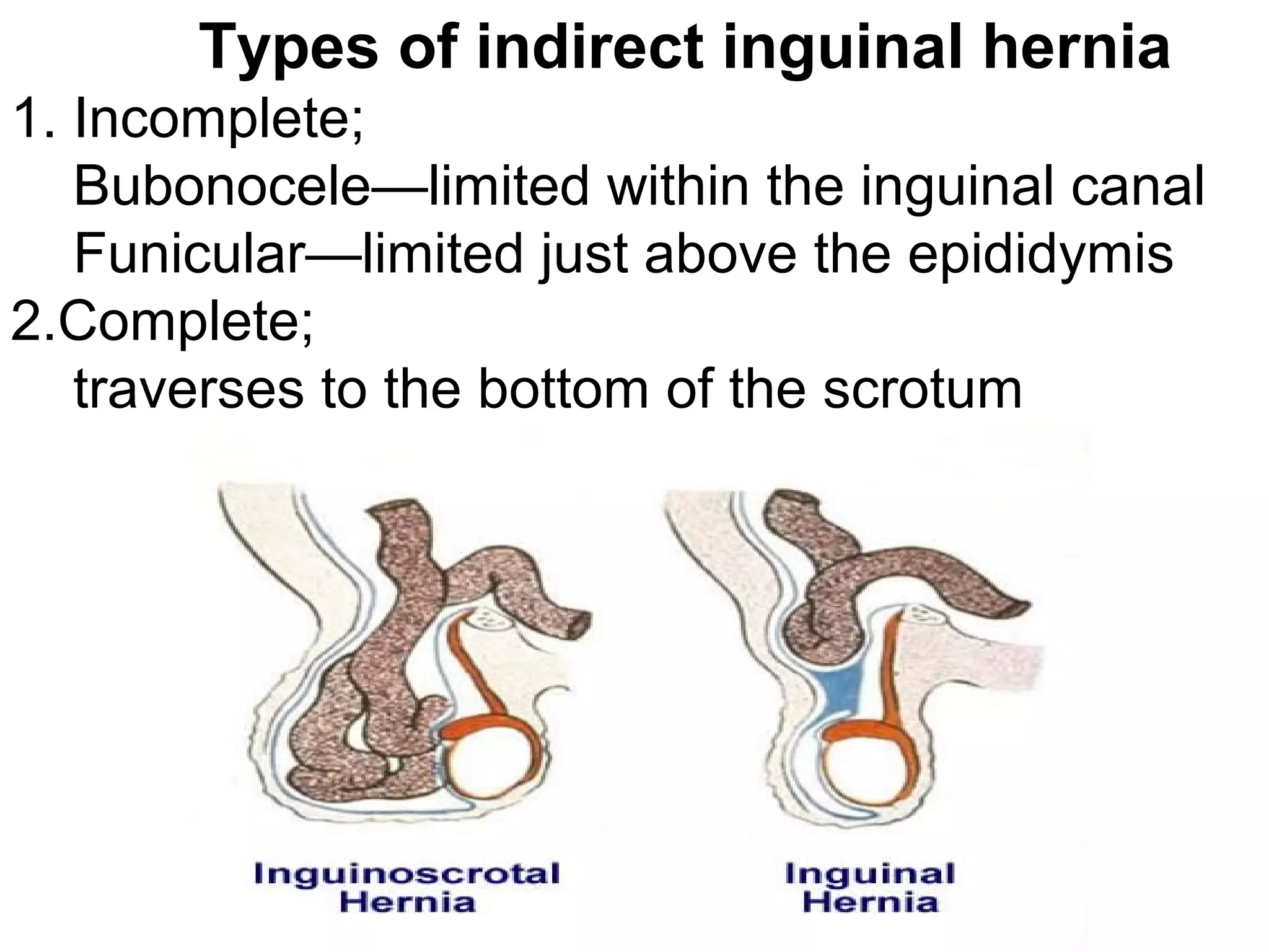 Types of indirect inguinal hernia
1. Incomplete;
Bubonocele—limited within the inguinal canal
Funicular—limited just above the epididymis
2.Complete;
traverses to the bottom of the scrotum
 