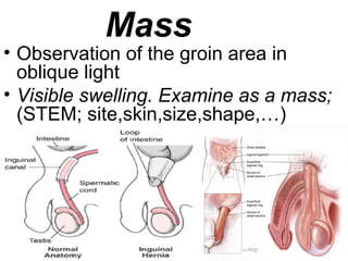 • Observation of the groin area in
oblique light
• Visible swelling. Examine as a mass;
(STEM; site,skin,size,shape,…)
Mass
 