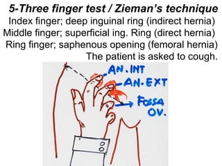 5-Three finger test / Zieman’s technique
Index finger; deep inguinal ring (indirect hernia)
Middle finger; superficial ing. Ring (direct hernia)
Ring finger; saphenous opening (femoral hernia)
The patient is asked to cough.
 