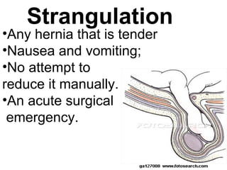 •Any hernia that is tender
•Nausea and vomiting;
•No attempt to
reduce it manually.
•An acute surgical
emergency.
Strangulation
 