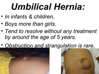 Umbilical Hernia:
• In infants & children.
• Boys more than girls.
• Tend to resolve without any treatment
by around the age of 5 years.
• Obstruction and strangulation is rare.
 