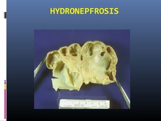 HYDRONEPFROSIS
 