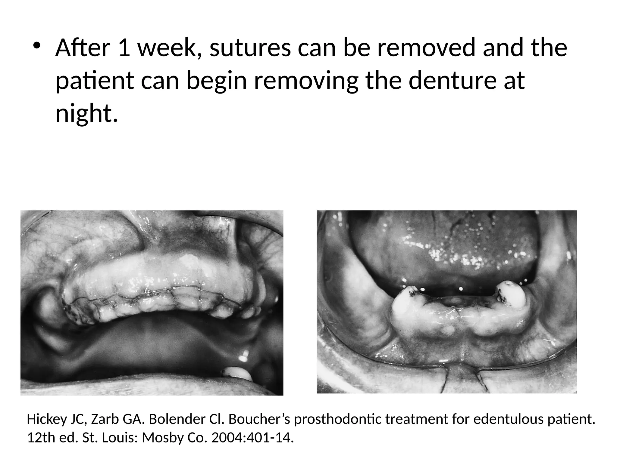 • After 1 week, sutures can be removed and the
patient can begin removing the denture at
night.
Hickey JC, Zarb GA. Bolender Cl. Boucher’s prosthodontic treatment for edentulous patient.
12th ed. St. Louis: Mosby Co. 2004:401-14.
 