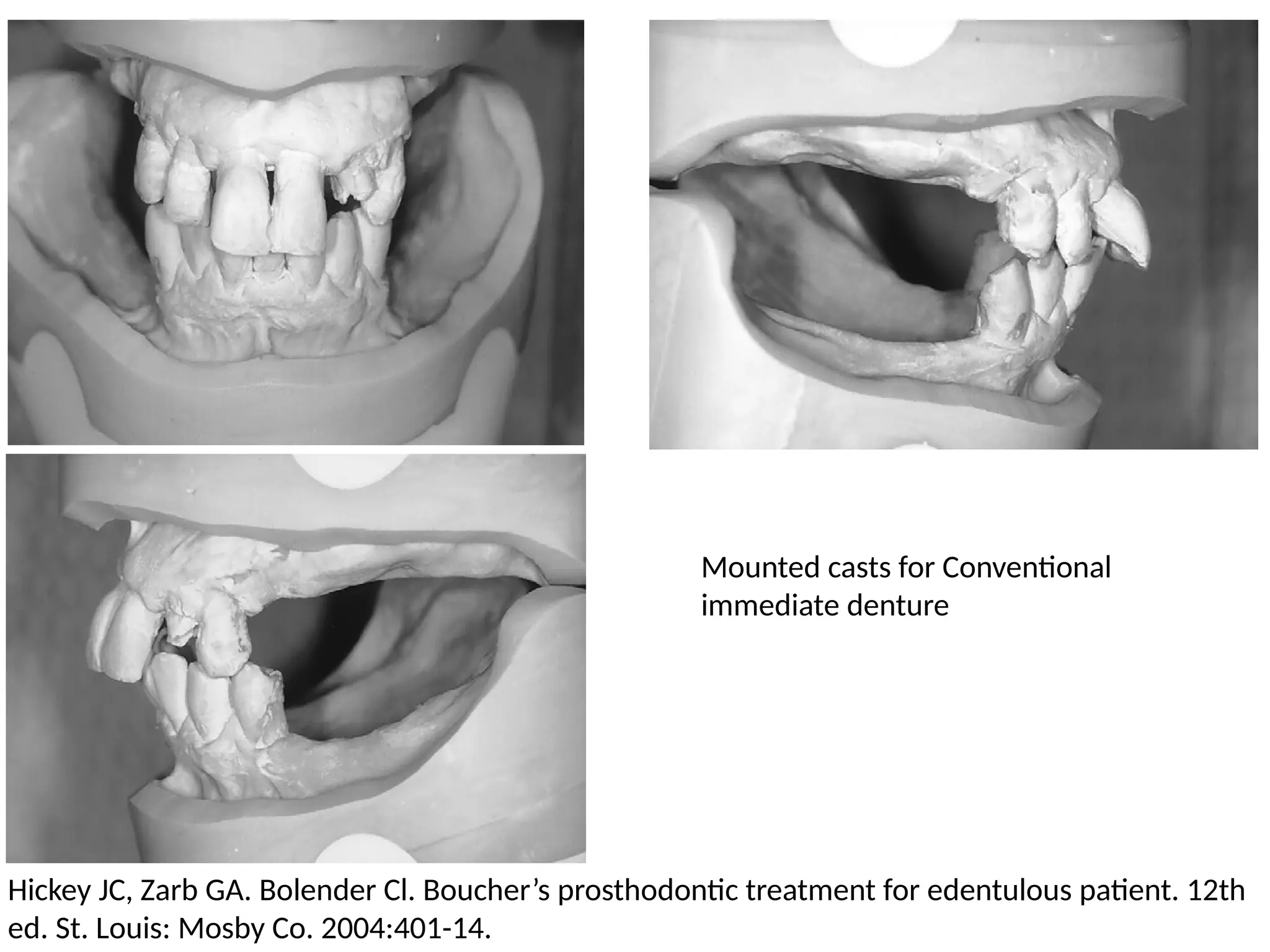 Mounted casts for Conventional
immediate denture
Hickey JC, Zarb GA. Bolender Cl. Boucher’s prosthodontic treatment for edentulous patient. 12th
ed. St. Louis: Mosby Co. 2004:401-14.
 
