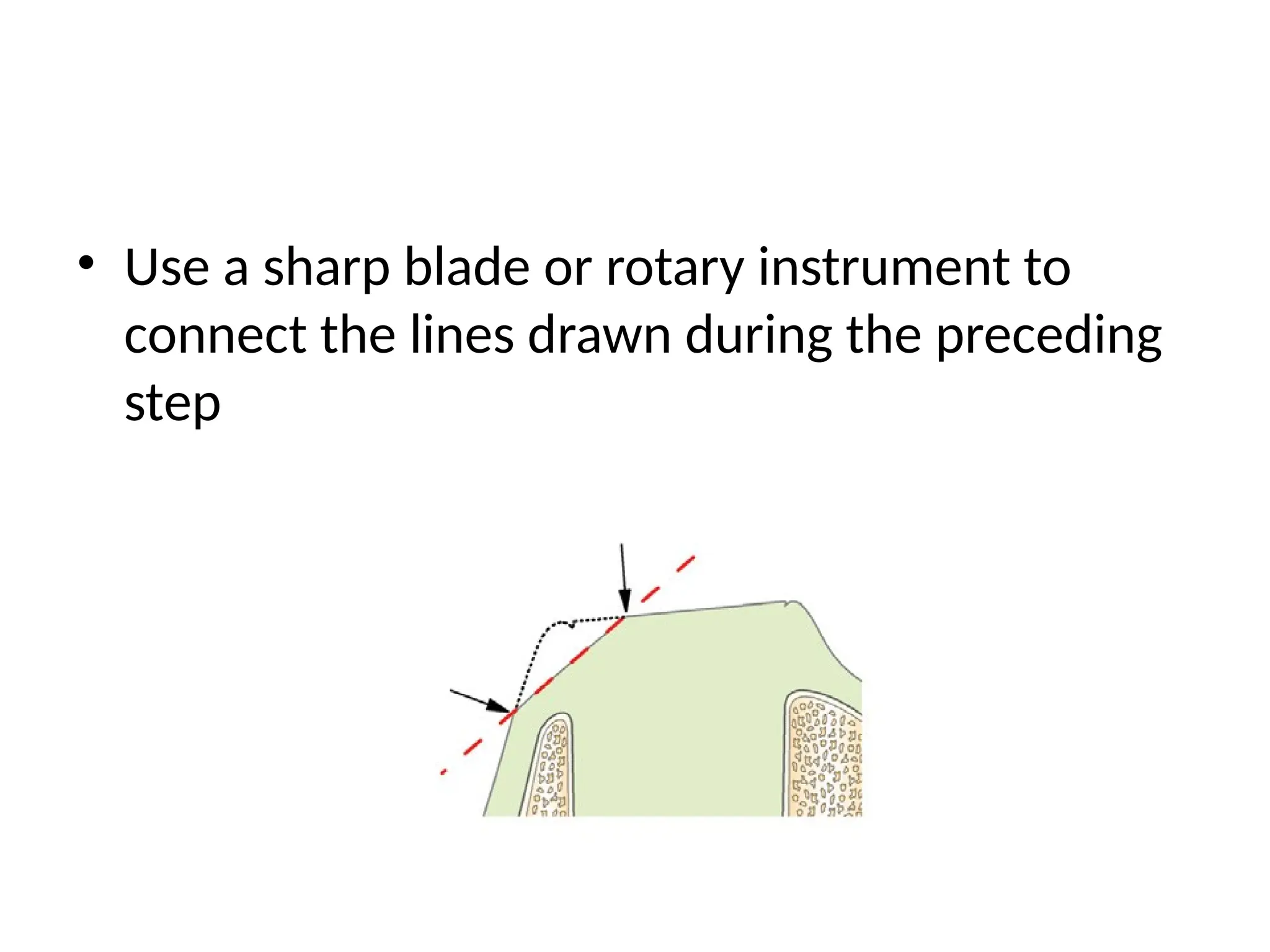 • Use a sharp blade or rotary instrument to
connect the lines drawn during the preceding
step
 