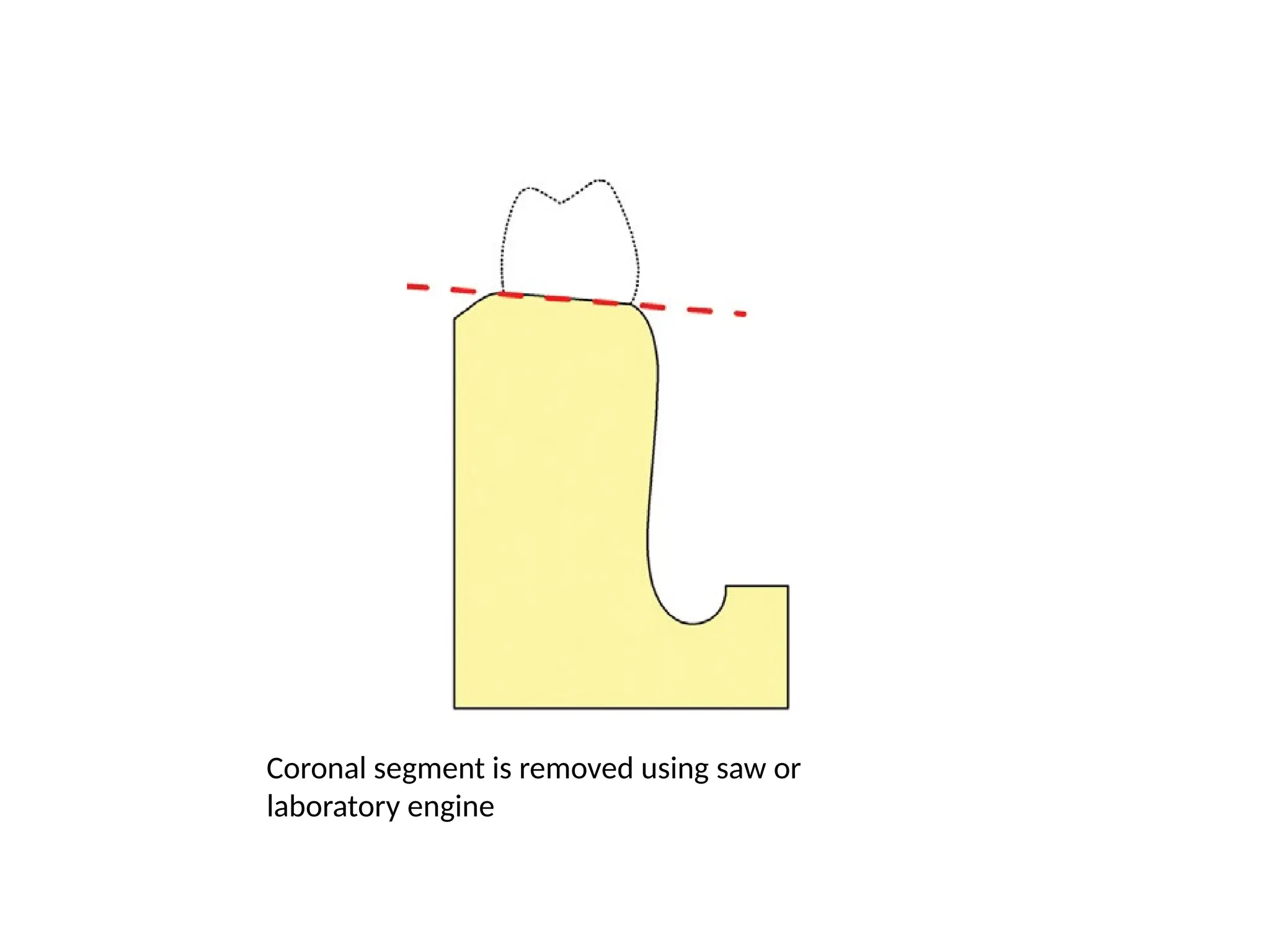 Coronal segment is removed using saw or
laboratory engine
 