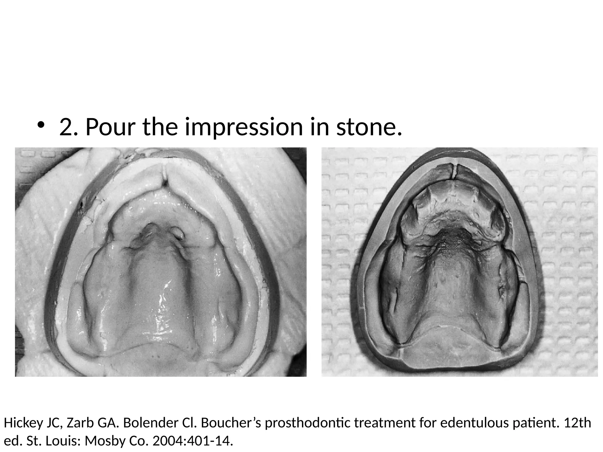 • 2. Pour the impression in stone.
Hickey JC, Zarb GA. Bolender Cl. Boucher’s prosthodontic treatment for edentulous patient. 12th
ed. St. Louis: Mosby Co. 2004:401-14.
 