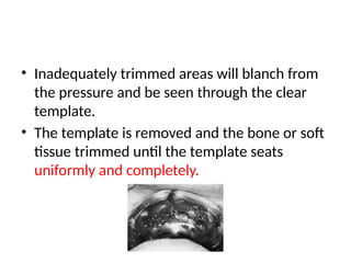 • Inadequately trimmed areas will blanch from
the pressure and be seen through the clear
template.
• The template is removed and the bone or soft
tissue trimmed until the template seats
uniformly and completely.
 