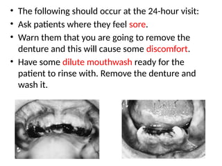 • The following should occur at the 24-hour visit:
• Ask patients where they feel sore.
• Warn them that you are going to remove the
denture and this will cause some discomfort.
• Have some dilute mouthwash ready for the
patient to rinse with. Remove the denture and
wash it.
 