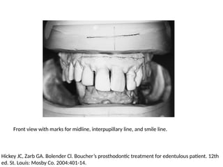 Front view with marks for midline, interpupillary line, and smile line.
Hickey JC, Zarb GA. Bolender Cl. Boucher’s prosthodontic treatment for edentulous patient. 12th
ed. St. Louis: Mosby Co. 2004:401-14.
 