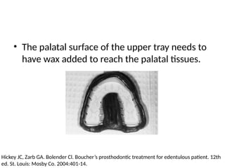 • The palatal surface of the upper tray needs to
have wax added to reach the palatal tissues.
Hickey JC, Zarb GA. Bolender Cl. Boucher’s prosthodontic treatment for edentulous patient. 12th
ed. St. Louis: Mosby Co. 2004:401-14.
 
