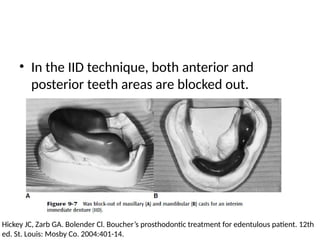 • In the IID technique, both anterior and
posterior teeth areas are blocked out.
Hickey JC, Zarb GA. Bolender Cl. Boucher’s prosthodontic treatment for edentulous patient. 12th
ed. St. Louis: Mosby Co. 2004:401-14.
 