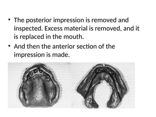 • The posterior impression is removed and
inspected. Excess material is removed, and it
is replaced in the mouth.
• And then the anterior section of the
impression is made.
 