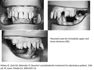 Mounted casts for immediate upper and
lower dentures (IID).
Hickey JC, Zarb GA. Bolender Cl. Boucher’s prosthodontic treatment for edentulous patient. 12th
ed. St. Louis: Mosby Co. 2004:401-14.
 