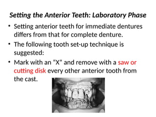 Setting the Anterior Teeth: Laboratory Phase
• Setting anterior teeth for immediate dentures
differs from that for complete denture.
• The following tooth set-up technique is
suggested:
• Mark with an “X” and remove with a saw or
cutting disk every other anterior tooth from
the cast.
 