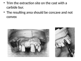 • Trim the extraction site on the cast with a
carbide bur.
• The resulting area should be concave and not
convex
 