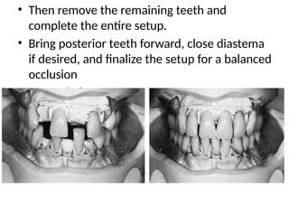 • Then remove the remaining teeth and
complete the entire setup.
• Bring posterior teeth forward, close diastema
if desired, and finalize the setup for a balanced
occlusion
• as needed
 