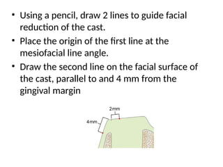 • Using a pencil, draw 2 lines to guide facial
reduction of the cast.
• Place the origin of the first line at the
mesiofacial line angle.
• Draw the second line on the facial surface of
the cast, parallel to and 4 mm from the
gingival margin
 
