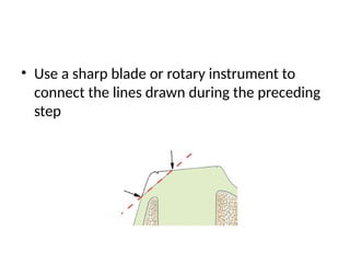 • Use a sharp blade or rotary instrument to
connect the lines drawn during the preceding
step
 