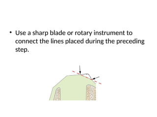 • Use a sharp blade or rotary instrument to
connect the lines placed during the preceding
step.
 
