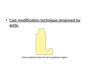 • Cast modification technique proposed by
Jerbi:
Cross-sectional view of cast in posterior region
 