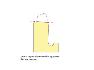 Coronal segment is removed using saw or
laboratory engine
 