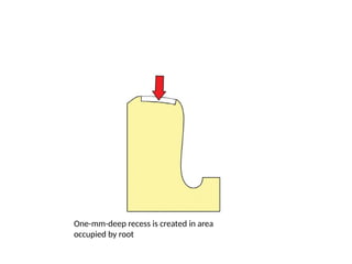 One-mm-deep recess is created in area
occupied by root
 