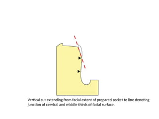 Vertical cut extending from facial extent of prepared socket to line denoting
junction of cervical and middle thirds of facial surface.
 