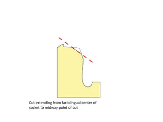 Cut extending from faciolingual center of
socket to midway point of cut
 