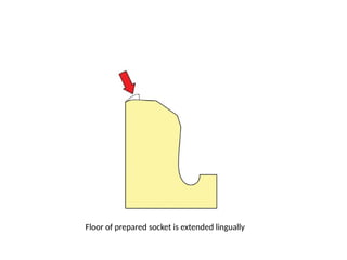 Floor of prepared socket is extended lingually
 