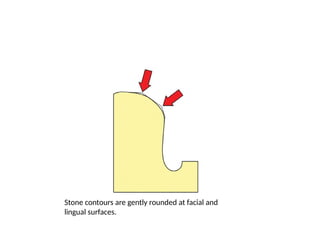 Stone contours are gently rounded at facial and
lingual surfaces.
 