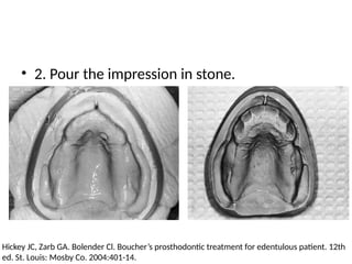 • 2. Pour the impression in stone.
Hickey JC, Zarb GA. Bolender Cl. Boucher’s prosthodontic treatment for edentulous patient. 12th
ed. St. Louis: Mosby Co. 2004:401-14.
 