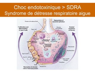 Choc endotoxinique > SDRA Syndrome de détresse respiratoire aigue 
